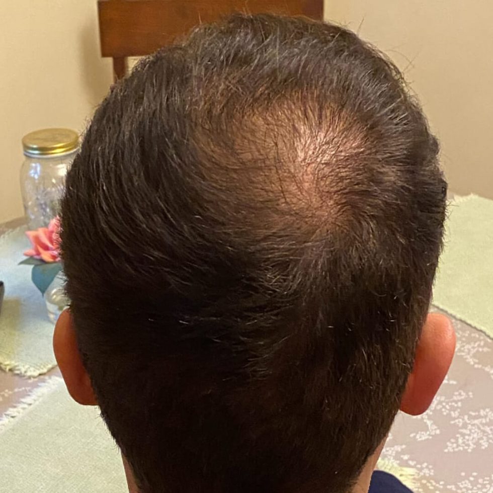 The Hairy Pill® Hair Loss Treatment for Men & Women